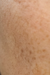 aloe vera benefits skin: blemishes